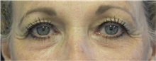 Eyelid Surgery Before Photo by Munique Maia, MD; Tysons Corner, VA - Case 48693