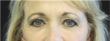 Eyelid Surgery Before Photo by Munique Maia, MD; Tysons Corner, VA - Case 48693