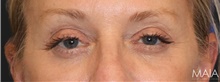 Eyelid Surgery After Photo by Munique Maia, MD; Tysons Corner, VA - Case 48694