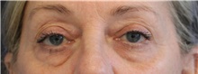 Eyelid Surgery Before Photo by Munique Maia, MD; Tysons Corner, VA - Case 48694