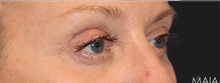 Eyelid Surgery After Photo by Munique Maia, MD; Tysons Corner, VA - Case 48694