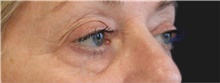 Eyelid Surgery Before Photo by Munique Maia, MD; Tysons Corner, VA - Case 48694