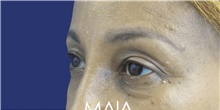 Eyelid Surgery Before Photo by Munique Maia, MD; Tysons Corner, VA - Case 48695