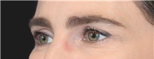 Eyelid Surgery Before Photo by Munique Maia, MD; Tysons Corner, VA - Case 48696