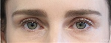 Eyelid Surgery After Photo by Munique Maia, MD; Tysons Corner, VA - Case 48696
