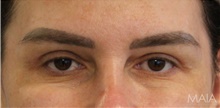 Eyelid Surgery After Photo by Munique Maia, MD; Tysons Corner, VA - Case 48697