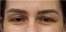 Eyelid Surgery Before Photo by Munique Maia, MD; Tysons Corner, VA - Case 48697