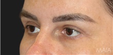 Eyelid Surgery After Photo by Munique Maia, MD; Tysons Corner, VA - Case 48697
