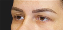 Eyelid Surgery Before Photo by Munique Maia, MD; Tysons Corner, VA - Case 48697