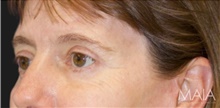Eyelid Surgery After Photo by Munique Maia, MD; Tysons Corner, VA - Case 48698