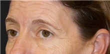 Eyelid Surgery Before Photo by Munique Maia, MD; Tysons Corner, VA - Case 48698