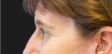 Eyelid Surgery After Photo by Munique Maia, MD; Tysons Corner, VA - Case 48698