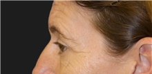 Eyelid Surgery Before Photo by Munique Maia, MD; Tysons Corner, VA - Case 48698