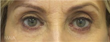 Eyelid Surgery After Photo by Munique Maia, MD; Tysons Corner, VA - Case 48699