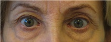 Eyelid Surgery Before Photo by Munique Maia, MD; Tysons Corner, VA - Case 48699