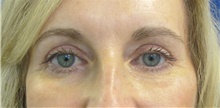 Eyelid Surgery After Photo by Munique Maia, MD; Tysons Corner, VA - Case 48700