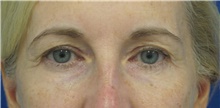 Eyelid Surgery Before Photo by Munique Maia, MD; Tysons Corner, VA - Case 48700