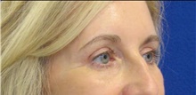 Eyelid Surgery After Photo by Munique Maia, MD; Tysons Corner, VA - Case 48700