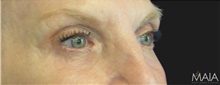 Eyelid Surgery After Photo by Munique Maia, MD; Tysons Corner, VA - Case 48701