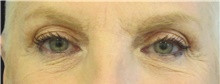 Eyelid Surgery Before Photo by Munique Maia, MD; Tysons Corner, VA - Case 48701