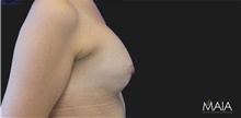 Breast Augmentation After Photo by Munique Maia, MD; Tysons Corner, VA - Case 48702