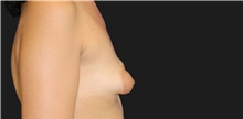 Breast Augmentation Before Photo by Munique Maia, MD; Tysons Corner, VA - Case 48702