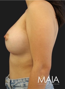 Breast Augmentation After Photo by Munique Maia, MD; Tysons Corner, VA - Case 48703