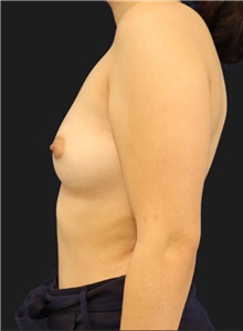 Breast Augmentation Before Photo by Munique Maia, MD; Tysons Corner, VA - Case 48703