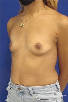 Breast Augmentation Before Photo by Munique Maia, MD; Tysons Corner, VA - Case 48708