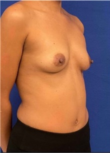 Breast Augmentation Before Photo by Munique Maia, MD; Tysons Corner, VA - Case 48710