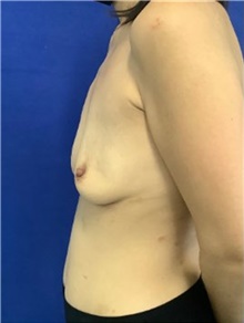 Breast Augmentation Before Photo by Munique Maia, MD; Tysons Corner, VA - Case 48712