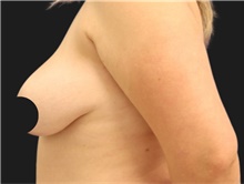 Breast Lift Before Photo by Munique Maia, MD; Tysons Corner, VA - Case 48717