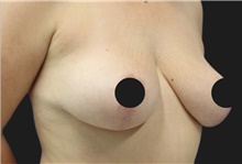 Breast Lift After Photo by Munique Maia, MD; Tysons Corner, VA - Case 48717