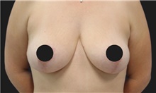 Breast Lift After Photo by Munique Maia, MD; Tysons Corner, VA - Case 48717
