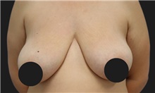Breast Lift Before Photo by Munique Maia, MD; Tysons Corner, VA - Case 48717