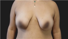 Breast Lift Before Photo by Munique Maia, MD; Tysons Corner, VA - Case 48719