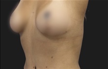 Breast Lift After Photo by Munique Maia, MD; Tysons Corner, VA - Case 48719