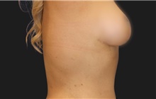Breast Lift After Photo by Munique Maia, MD; Tysons Corner, VA - Case 48719