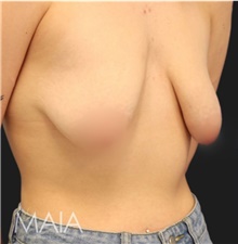 Breast Lift Before Photo by Munique Maia, MD; Tysons Corner, VA - Case 48720