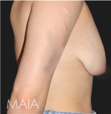 Breast Lift Before Photo by Munique Maia, MD; Tysons Corner, VA - Case 48720