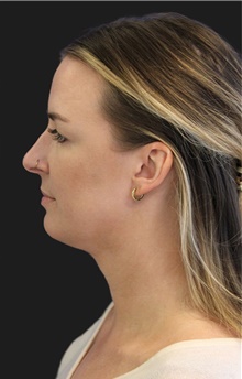Liposuction After Photo by Munique Maia, MD; Tysons Corner, VA - Case 48742