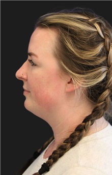 Liposuction Before Photo by Munique Maia, MD; Tysons Corner, VA - Case 48742