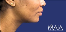Liposuction After Photo by Munique Maia, MD; Tysons Corner, VA - Case 48743