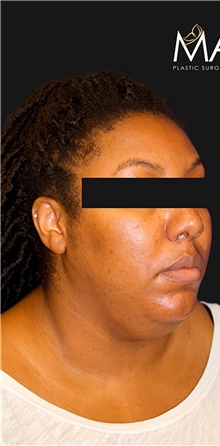 Liposuction Before Photo by Munique Maia, MD; Tysons Corner, VA - Case 48744