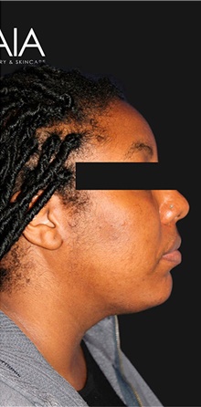Liposuction After Photo by Munique Maia, MD; Tysons Corner, VA - Case 48744