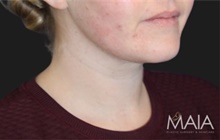 Liposuction After Photo by Munique Maia, MD; Tysons Corner, VA - Case 48745