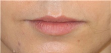 Injectable Fillers Before Photo by Munique Maia, MD; Tysons Corner, VA - Case 48747