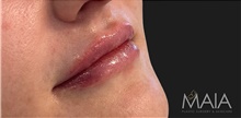 Injectable Fillers After Photo by Munique Maia, MD; Tysons Corner, VA - Case 48748