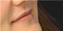 Injectable Fillers Before Photo by Munique Maia, MD; Tysons Corner, VA - Case 48748