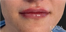 Injectable Fillers After Photo by Munique Maia, MD; Tysons Corner, VA - Case 48748